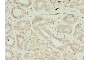 Immunohistochemistry of paraffin-embedded human breast cancer using ABIN7175188 at dilution of 1:100 (VSIG2 抗体  (AA 24-243))