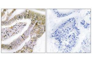 Immunohistochemistry analysis of paraffin-embedded human lung carcinoma tissue using TACC3 antibody. (TACC3 抗体  (C-Term))