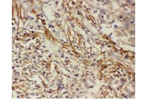 Immunohistochemistry analysis of paraffin-embedded human lung cancer tissue using COX2 Antibody (1/200 dilution). (COX2 抗体)
