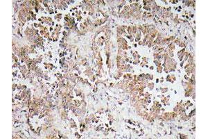 Immunohistochemical analysis of paraffin-embedded human lung cancer tissue using OR6P1 polyclonal antibody . (OR6P1 抗体)