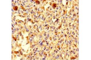 Immunohistochemistry of paraffin-embedded human melanoma using ABIN7146155 at dilution of 1:100 (C2 Calcium-Dependent Domain-Containing Protein 6 (C2CD6) (AA 401-623) 抗体)