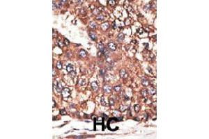Formalin-fixed and paraffin-embedded human hepatocellular carcinoma tissue reacted with LEPR polyclonal antibody  , which was peroxidase-conjugated to the secondary antibody, followed by DAB staining. (Leptin Receptor 抗体  (N-Term))