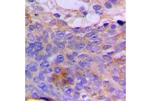 Immunohistochemical analysis of CSGALNACT1 staining in human breast cancer formalin fixed paraffin embedded tissue section. (CSGALNACT1 抗体  (Center))