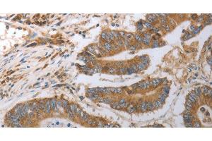 Immunohistochemistry of paraffin-embedded Human colon cancer using SLC22A6 Polyclonal Antibody at dilution of 1:40 (SLC22A6 抗体)