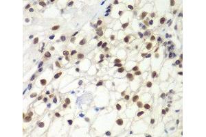 Immunohistochemistry of paraffin-embedded Human kidney cancer using MSH6 Polyclonal Antibody at dilution of 1:100 (40x lens). (MSH6 抗体)