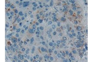 Detection of SMAD5 in Human Liver cancer Tissue using Polyclonal Antibody to SMAD family member 5 (SMAD5) (SMAD5 抗体  (AA 210-464))
