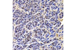 Immunohistochemistry of paraffin-embedded human liver cancer using HIRIP3 antibody (ABIN5974221) at dilution of 1/100 (40x lens). (HIRIP3 抗体)