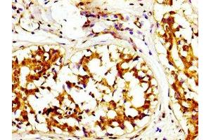 IHC image of ABIN7146664 diluted at 1:200 and staining in paraffin-embedded human breast cancer performed on a Leica BondTM system. (Caprin-1 抗体  (AA 573-703))