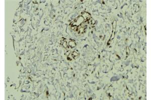 ABIN6272857 at 1/100 staining Human breast cancer tissue by IHC-P. (VPRBP 抗体)