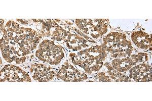 Immunohistochemistry of paraffin-embedded Human esophagus cancer tissue using ATXN7L3 Polyclonal Antibody at dilution of 1:35(x200) (ATXN7L3 抗体)