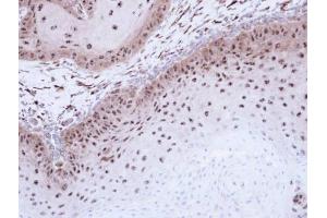 IHC-P Image Immunohistochemical analysis of paraffin-embedded Cal27 xenograft , using DMC1, antibody at 1:500 dilution. (DMC1 抗体  (Center))