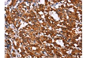 The image on the left is immunohistochemistry of paraffin-embedded Human thyroid cancer tissue using ABIN7190857(GPR65 Antibody) at dilution 1/15, on the right is treated with synthetic peptide. (GPR65 抗体)