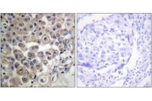 Immunohistochemistry analysis of paraffin-embedded human breast carcinoma tissue, using PLC beta3 (Ab-537) Antibody. (PLCB3 抗体  (AA 503-552))