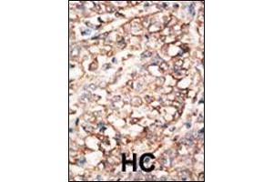 Formalin-fixed and paraffin-embedded human cancer tissue reacted with the primary antibody, which was peroxidase-conjugated to the secondary antibody, followed by AEC staining. (BMPR1A 抗体  (C-Term))