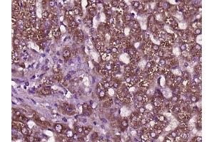 Paraformaldehyde-fixed, paraffin embedded human liver cancer, Antigen retrieval by boiling in sodium citrate buffer (pH6) for 15min, Block endogenous peroxidase by 3% hydrogen peroxide for 30 minutes,  Blocking buffer (normal goat serum) at 37°C for 20min, Antibody incubation with SCD1 Polyclonal Antibody (bs-3787R) at 1:400 overnight at 4°C, followed by a conjugated secondary and DAB staining. (SCD 抗体  (AA 265-359))