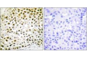 Immunohistochemistry analysis of paraffin-embedded human breast carcinoma tissue, using Histone H2B (Ab-15) Antibody.