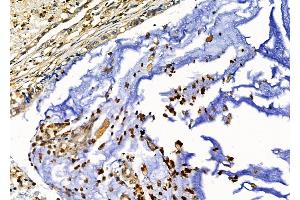 ABIN6257408 and ABIN6276235 at 1/100 staining Human gastric cancer by IHC-P.