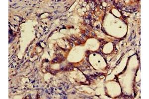 Immunohistochemistry of paraffin-embedded human colon cancer using ABIN7170356 at dilution of 1:100 (SNX15 抗体  (AA 144-321))