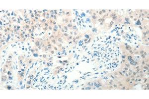 Immunohistochemistry of paraffin-embedded Human lung cancer tissue using RAB25 Polyclonal Antibody at dilution 1:50 (RAB25 抗体)