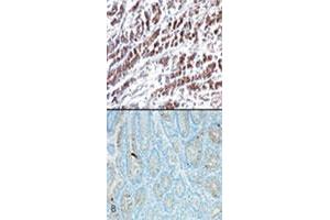 IHC testing using HTRA2 monoclonal antibody, clone 196C429  shows cytoplasmic staining in stomach tumor tissue (A) and very weak staining in normal stomach tissue (B) . (HTRA2 抗体  (AA 335-350))