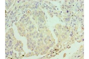 Immunohistochemistry of paraffin-embedded human lung cancer using ABIN7171956 at dilution of 1:100 (ERCC2 抗体  (AA 1-300))