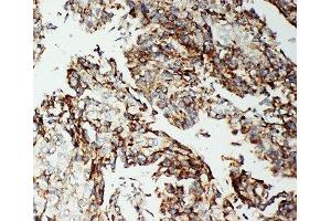 IHC-P: Apoptosis-Inducing Factor antibody testing of human lung cancer tissue (AIF 抗体  (C-Term))
