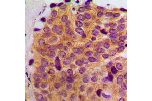 Immunohistochemical analysis of MAST2 staining in human breast cancer formalin fixed paraffin embedded tissue section. (MAST2 抗体  (Center))