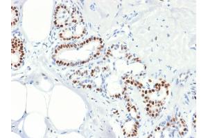 Formalin-fixed, paraffin-embedded human Breast Carcinoma stained with Estrogen Receptor, alpha Mouse Recombinant Monoclonal Antibody (rESR1/1935). (Recombinant Estrogen Receptor alpha 抗体)