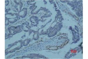 Immunohistochemistry (IHC) analysis of paraffin-embedded Human Colon Carcicnoma using Survivin Monoclonal Antibody. (Survivin 抗体)