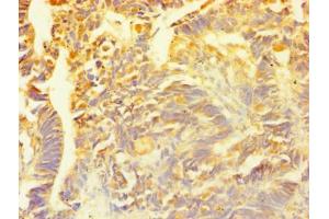 Immunohistochemistry of paraffin-embedded human ovarian cancer using ABIN7153564 at dilution of 1:100 (SNCG 抗体  (AA 1-127))