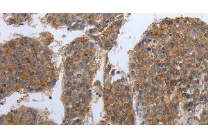 Immunohistochemistry of paraffin-embedded Human liver cancer tissue using PDIA2 Polyclonal Antibody at dilution 1:50 (PDIA2 抗体)