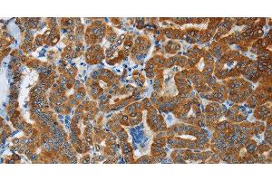 Immunohistochemistry of paraffin-embedded Human thyroid cancer tissue using FLCN Polyclonal Antibody at dilution 1:40 (FLCN 抗体)