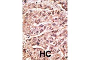 Formalin-fixed and paraffin-embedded human hepatocellular carcinoma tissue reacted with the SUMO4 polyclonal antibody  , which was peroxidase-conjugated to the secondary antibody, followed by DAB staining. (SUMO4 抗体  (Val55))
