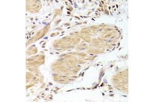 Immunohistochemistry of paraffin-embedded human gastric cancer using CASP2 Antibody. (Caspase 2 抗体  (AA 153-452))