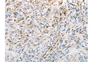 The image on the left is immunohistochemistry of paraffin-embedded Human gastic cancer tissue using ABIN7191692(NPPC Antibody) at dilution 1/70, on the right is treated with synthetic peptide. (NPPC 抗体)