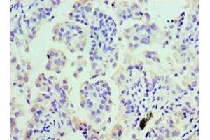 Immunohistochemistry of paraffin-embedded human lung cancer using ABIN7147984 at dilution of 1:100 (COTL1 抗体  (AA 1-142))