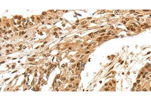 Immunohistochemistry of paraffin-embedded Human esophagus cancer using SPATA20 Polyclonal Antibody at dilution of 1:70 (SPATA20 抗体)