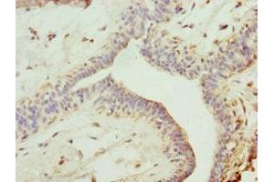 Immunohistochemistry of paraffin-embedded human breast cancer using ABIN7151243 at dilution of 1:100 (TRIM13 抗体  (AA 40-310))