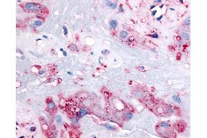 Anti-RARB antibody IHC of human intermediate trophoblasts. (Retinoic Acid Receptor beta 抗体  (C-Term))