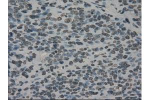 Immunohistochemical staining of paraffin-embedded Carcinoma of bladder tissue using anti-PRKYmouse monoclonal antibody. (PRKY 抗体)