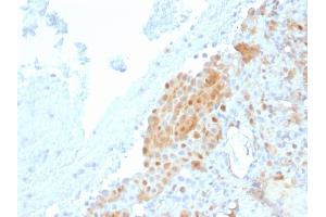 Formalin-fixed, paraffin-embedded human Mesothelioma stained with Calretinin Mouse Monoclonal Antibody (CALB2/2685). (Calretinin 抗体  (AA 23-242))