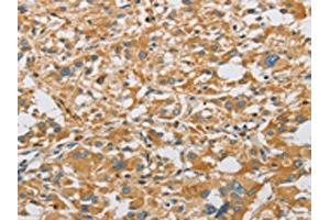 The image on the left is immunohistochemistry of paraffin-embedded Human thyroid cancer tissue using ABIN7128504(ARHGEF7 Antibody) at dilution 1/40, on the right is treated with fusion protein. (ARHGEF7 抗体)