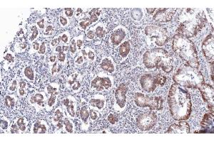 IHC-P Image Immunohistochemical analysis of paraffin-embedded human gastric cancer, using PSKH2, antibody at 1:100 dilution. (PSKH2 抗体)