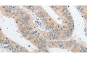 Immunohistochemistry of paraffin-embedded Human colon cancer using PLPP1 Polyclonal Antibody at dilution of 1:40 (PLPP1 抗体)