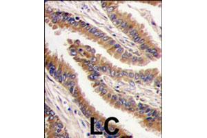 Formalin-fixed and paraffin-embedded human lung carcinoma tissue reacted with PRKX polyclonal antibody  , which was peroxidase-conjugated to the secondary antibody, followed by DAB staining. (PRKX 抗体  (C-Term))