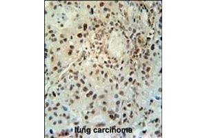 ABHEB Antibody (C-term) (ABIN653654 and ABIN2842995) immunohistochemistry analysis in formalin fixed and paraffin embedded human lung carcinoma followed by peroxidase conjugation of the secondary antibody and DAB staining. (ABHD14B 抗体  (C-Term))