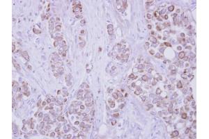 IHC-P Image Immunohistochemical analysis of paraffin-embedded human breast cancer, using CD82, antibody at 1:250 dilution. (CD82 抗体  (C-Term))