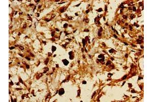 Immunohistochemistry of paraffin-embedded human melanoma using ABIN7154494 at dilution of 1:100 (PIK3R1 抗体  (AA 15-180))