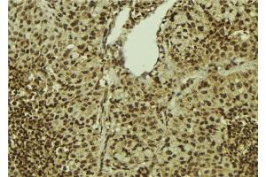 ABIN6272401 at 1/100 staining Human breast cancer tissue by IHC-P. (PRPF31 抗体  (Internal Region))