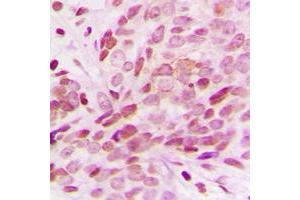 Immunohistochemical analysis of G15 staining in human breast cancer formalin fixed paraffin embedded tissue section. (AGPAT1 抗体  (Center))